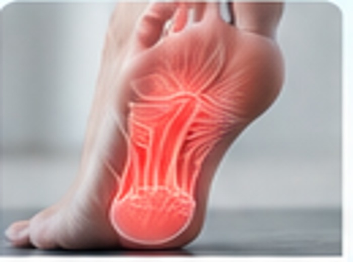 Fascitis plantar