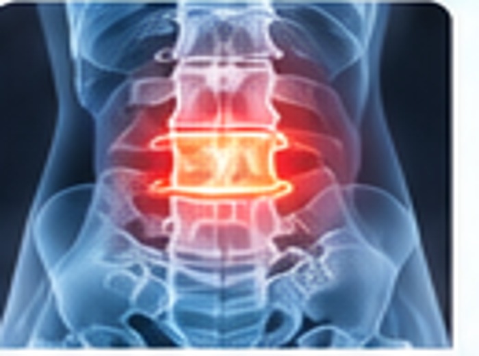 Hernias discales